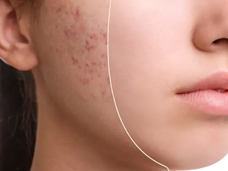 مزونیدلینگ مزایا، عوارض و هزینه