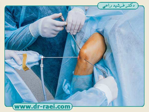 تأثیر روش آرتروسکوپی در منیسک