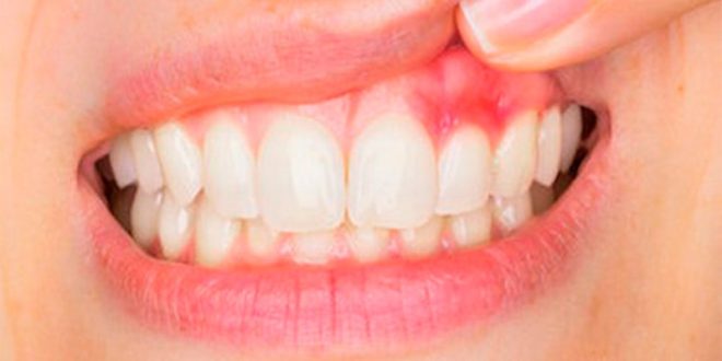 عوارض بیماری های لثه را جدی بگیریم!