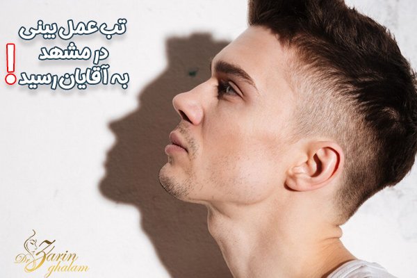 تب عمل بینی در مشهد به آقایان رسید