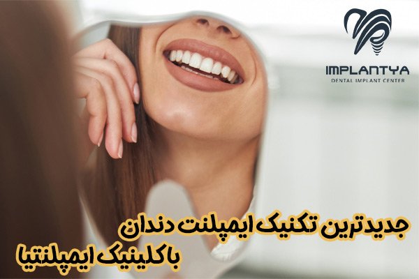 جدیدترین تکنیک ایمپلنت دندان با کلینیک ایمپلنتیا