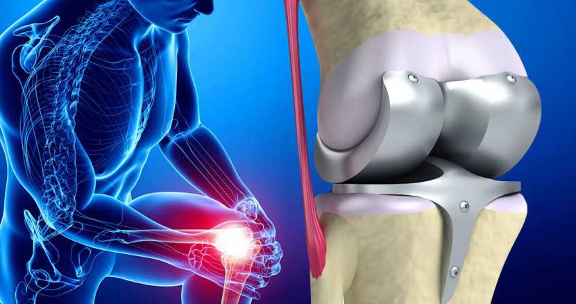 بهترین پزشک عمل تعویض مفصل زانو