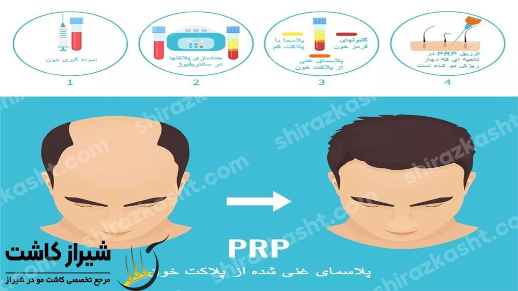 پی ار پی پس از کاشت مو بهتر از 1000 نوع مکمل تقویتی
