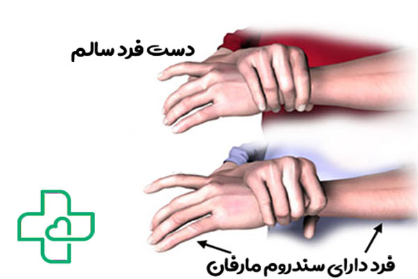 نشانگاه مورفان چیست؟ چه چیز هایی از آن باید بدانیم؟