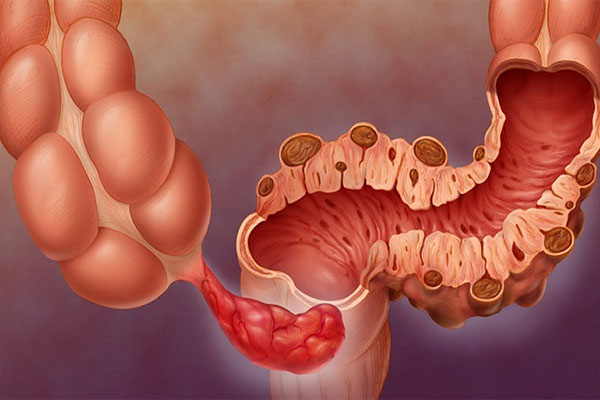 بیماری دیورتیکولیت روده چیست؟ علائم + تشخیص و درمان