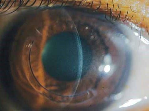 تمام چیزی که باید در مورد تاثیر قوز قرنیه بر دید بدانید