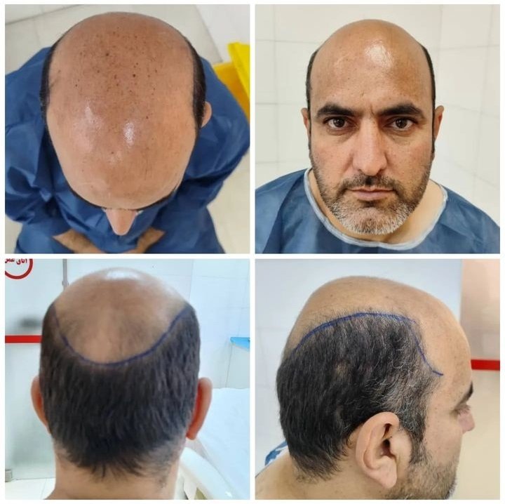 نکات مهم بایدها و نبایدهای قبل و بعد از کاشت مو