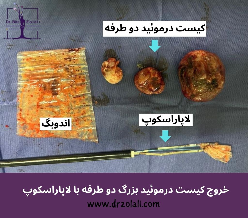 کیست درموئید تخمدان؛ عامل خاموش نازایی