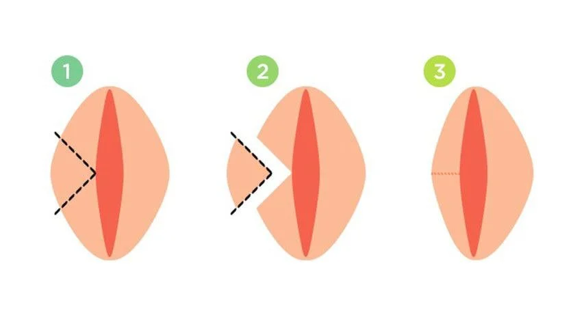 هزینه عمل زیبایی لابیاپلاستی در تهران