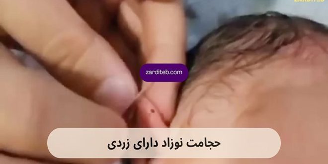 درمان زردی نوزاد با طب سنتی بهتر است یا دستگاه فتوتراپی؟
