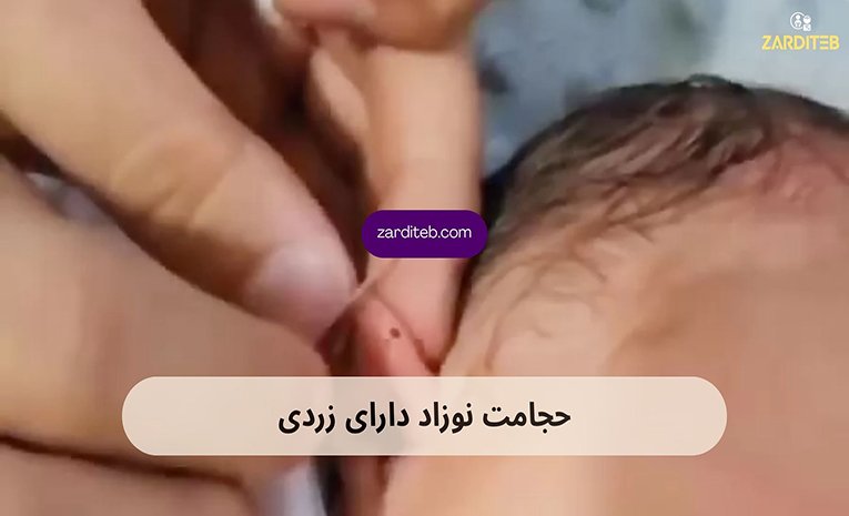 درمان زردی نوزاد با طب سنتی بهتر است یا دستگاه فتوتراپی؟