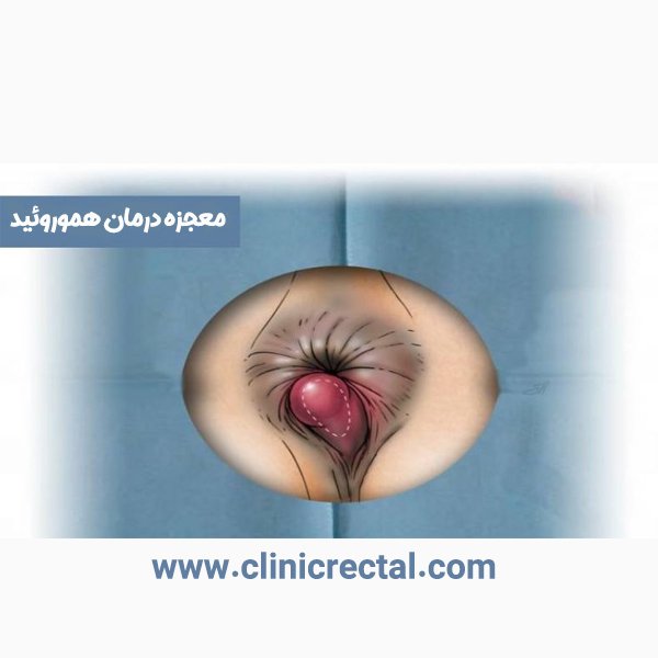 معجزه درمان هموروئید