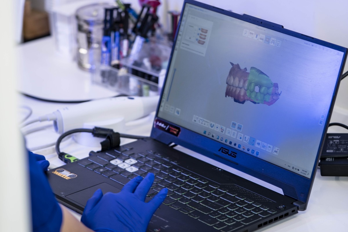 اوردنچر فک پایین چیست؟