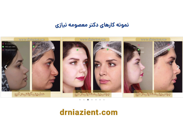 جراحی بینی طبیعی و هماهنگ با چهره
