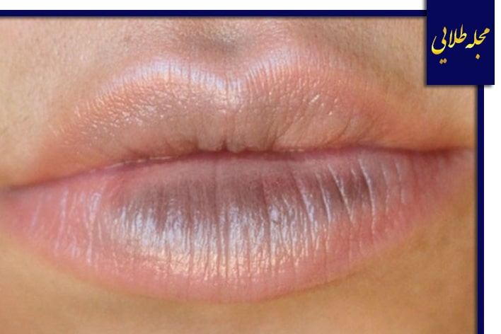 عوامل موثر در تیرگی لب