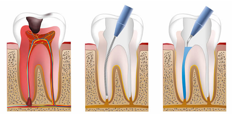 چطور هزینه عصب کشی دندان را به صورت اقساطی پرداخت کنیم؟