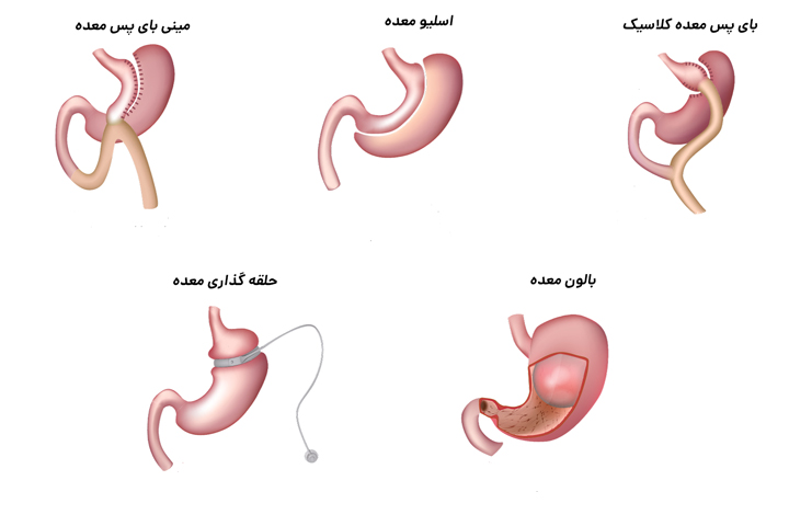 انواع عمل لاغری
