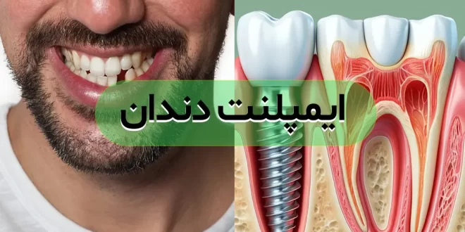 ایمپلنت دندان از صفر تا 100: هر آنچه باید درباره مراحل، مراقبت‌ها و هزینه‌ها بدانید