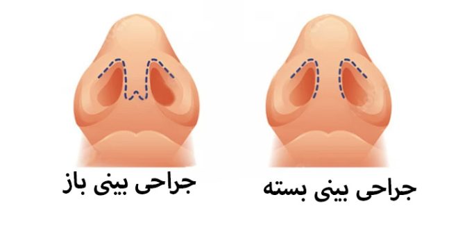 صفر تا صد جراحی بینی یا رینوپلاستی به روش باز