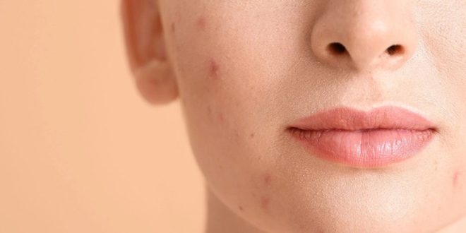 کرم ضدلک خارجی خوب کدام است؟