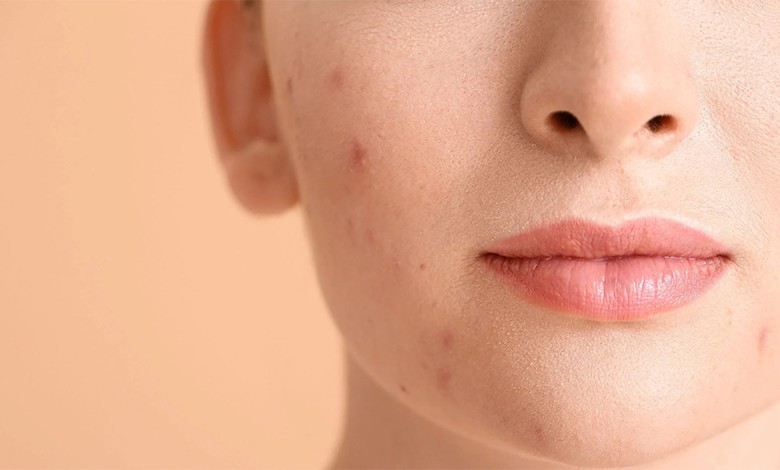 کرم ضدلک خارجی خوب کدام است؟