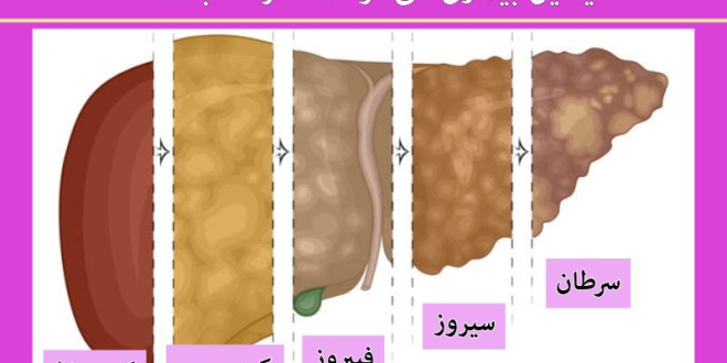 کبد چرب و سرطان؛ آیا این بیماری می‌تواند خطرناک باشد؟