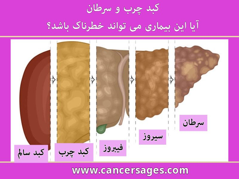 کبد چرب و سرطان؛ آیا این بیماری می‌تواند خطرناک باشد؟