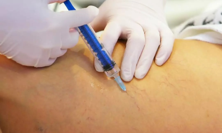 این درمان واریس را 99٪ مردم نمی‌ شناسند! اما نتایجش باورنکردنی است!