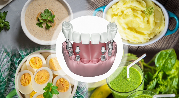 بعد از ایمپلنت چی بخوریم؟