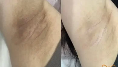 روشن سازی نواحی تیره بدن در مشهد | 3 روش قطعی + معرفی بهترین کلینیک