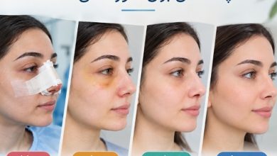روز اول تا روز سی‌ام بعد از عمل بینی؛ چه اتفاقی برای صورت می‌افتد؟