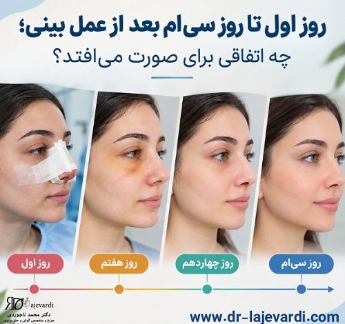 روز اول تا روز سی‌ام بعد از عمل بینی؛ چه اتفاقی برای صورت می‌افتد؟